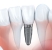 Implantes dentales