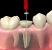 Endodoncia